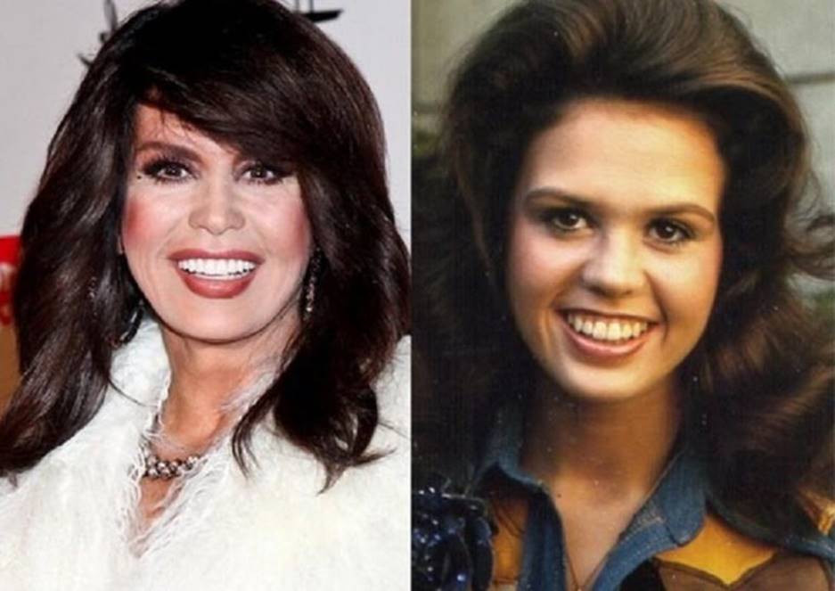 Marie Osmond Before and After