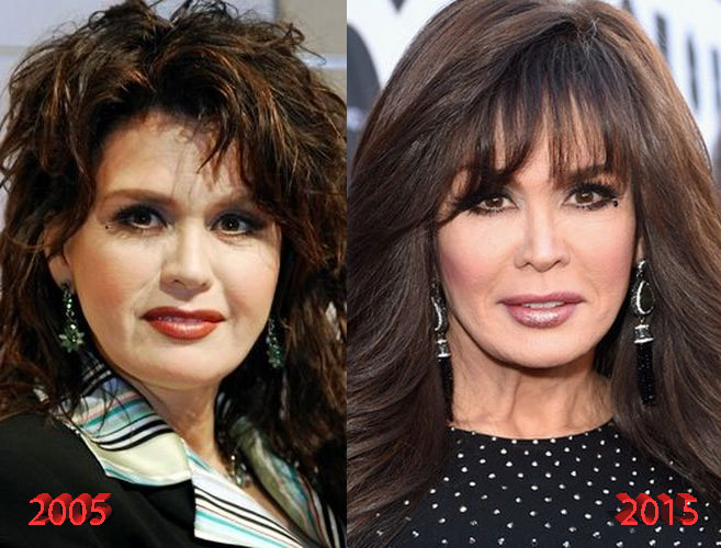 Marie Osmond Before and After