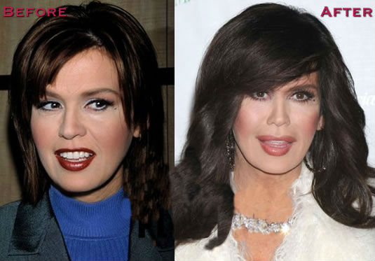 Marie Osmond Before and After