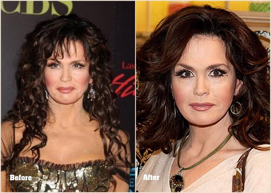 Marie Osmond Before and After