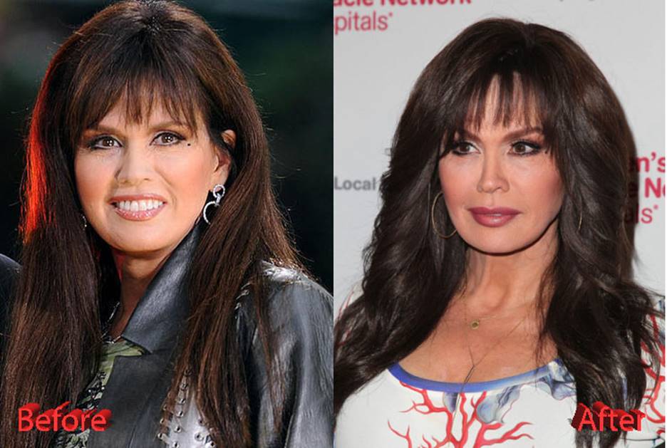 Marie Osmond Before and After