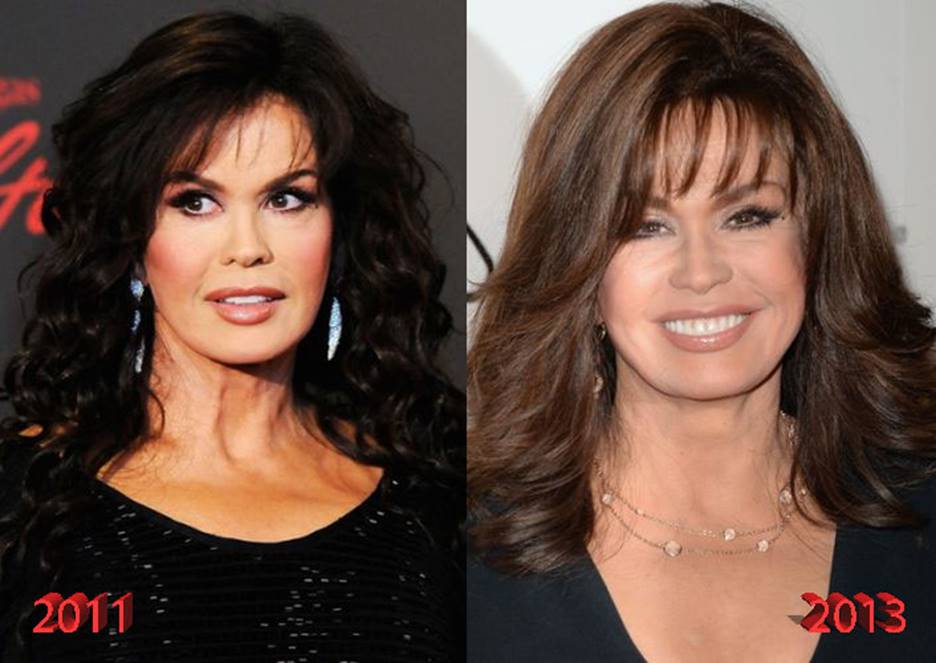 Marie Osmond Before and After